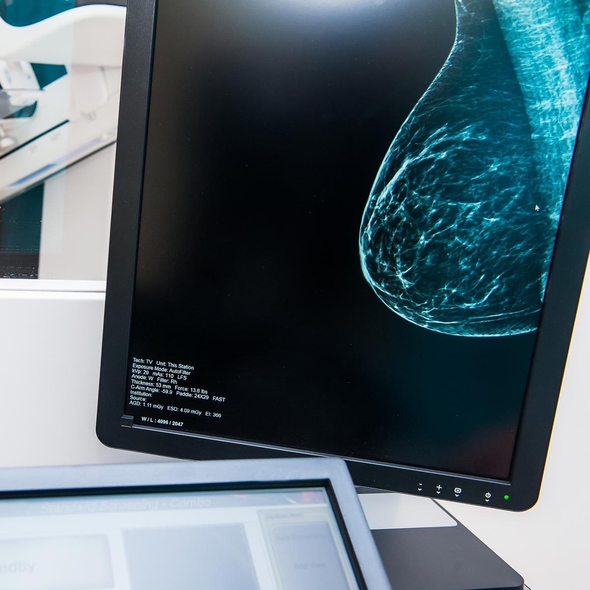 view of screen with medical scan of breast tissue